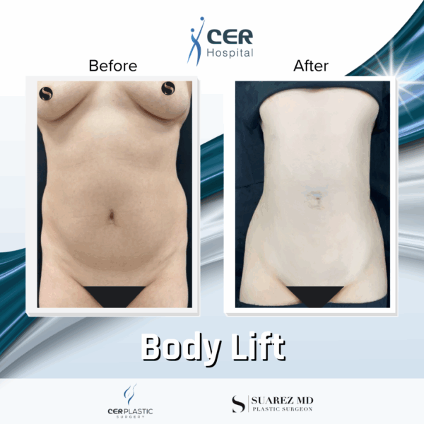Body Lift - 284 - Image 4