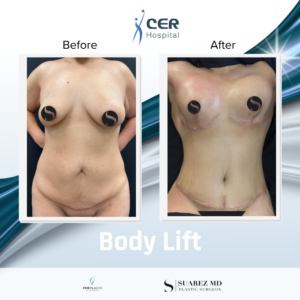 Body Lift – 210325
