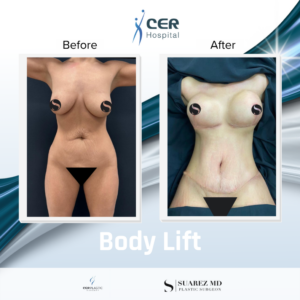 Body Lift – 120525