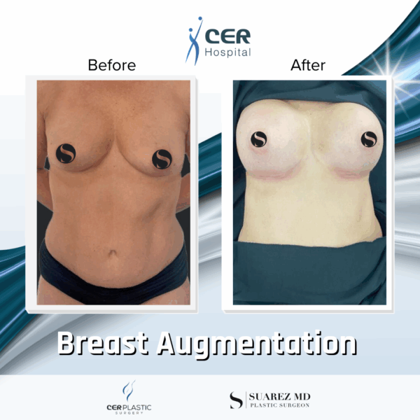 Breast Augmentation - 103 - Image 4