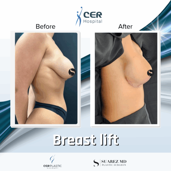 Breast Lift - 103 - Image 4