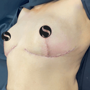 Breast Lift with Implant Removal – 5064