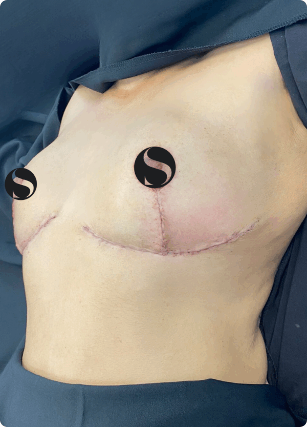 Breast Lift with Implant Removal - 5064 - Image 2