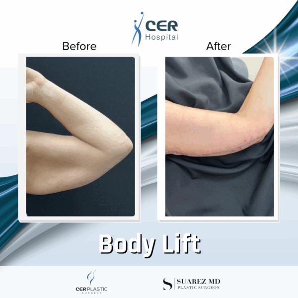 Body Lift - 165 - Image 12
