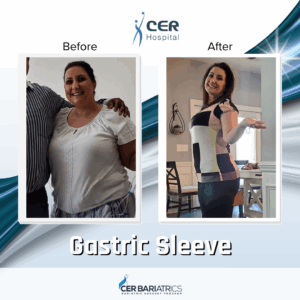 Gastric Sleeve