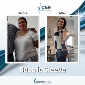 Gastric Sleeve
