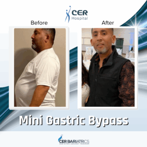 Mini Gastric Bypass