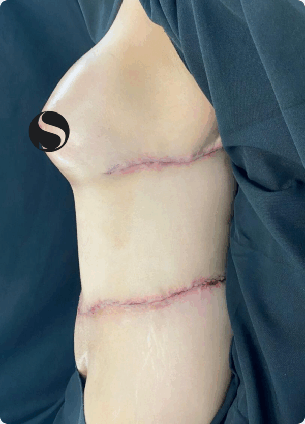 Body Lift - 037 - Image 2