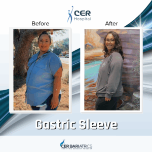 Gastric Sleeve