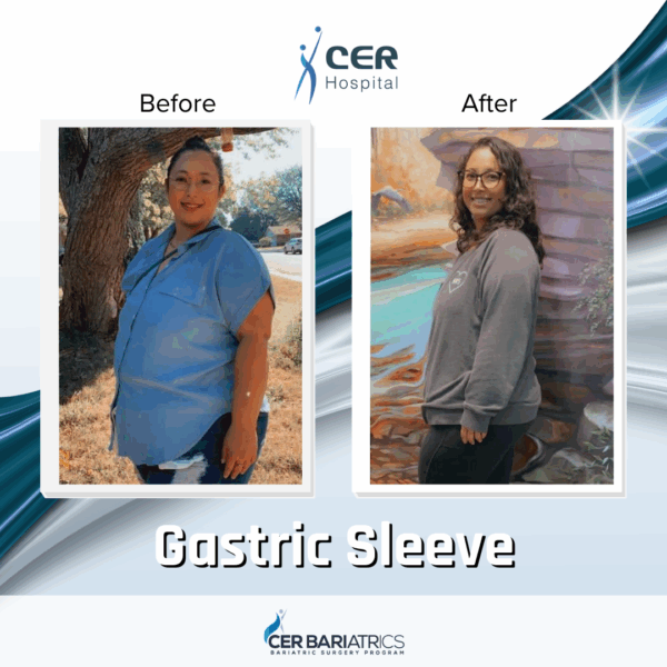 Gastric Sleeve