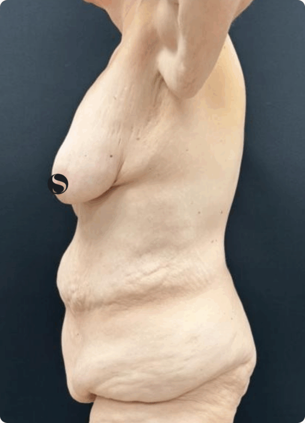 Body Lift - 075 - Image 3