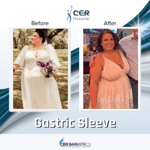 Gastric Sleeve