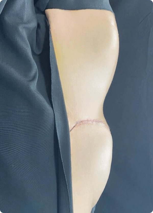 Body Lift - 075 - Image 2