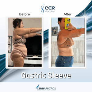 Gastric Sleeve