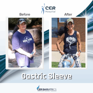 Gastric Sleeve