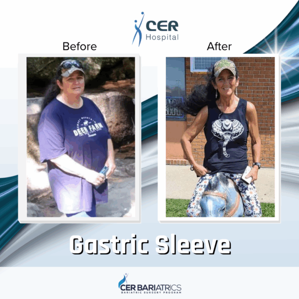 Gastric Sleeve