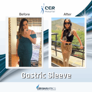 Gastric Sleeve