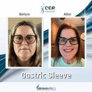 Gastric Sleeve
