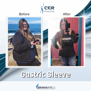 Gastric Sleeve
