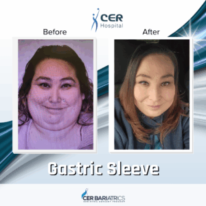 Gastric Sleeve