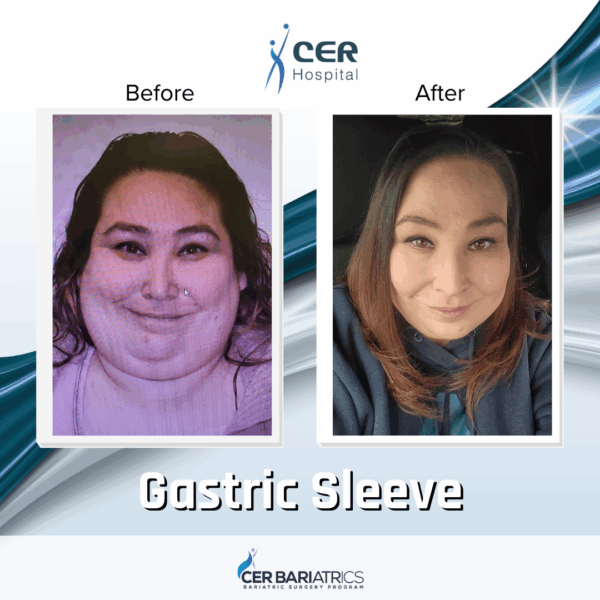 Gastric Sleeve