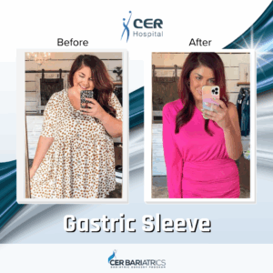 Gastric Sleeve