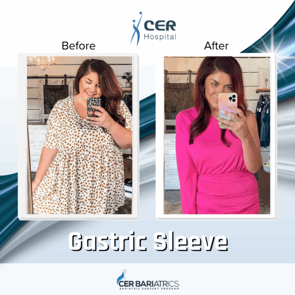 Gastric Sleeve