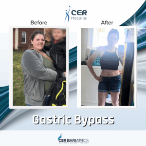 Gastric Bypass