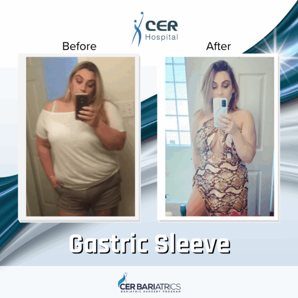 Gastric Sleeve