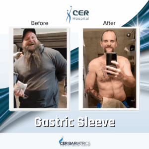 Gastric Sleeve