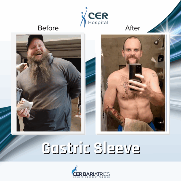 Gastric Sleeve