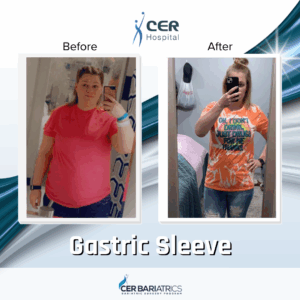 Gastric Sleeve