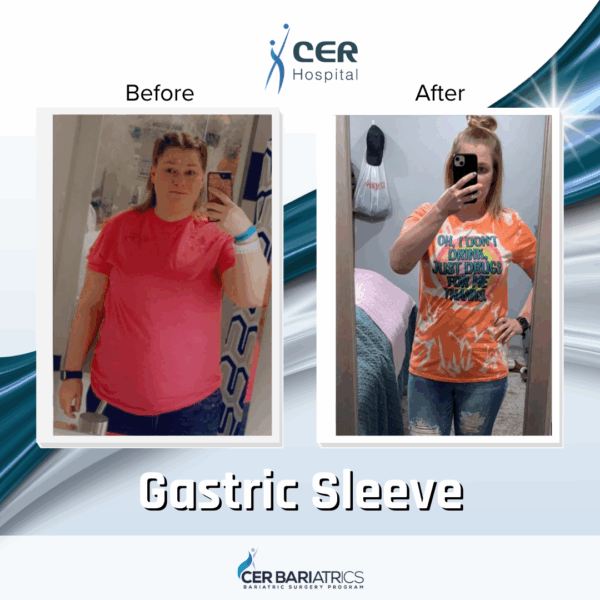 Gastric Sleeve