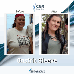 Gastric Sleeve