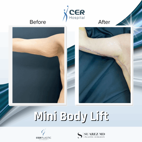 Mini Body Lift - 073 - Image 5