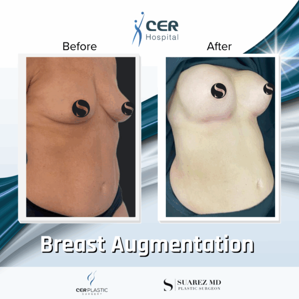 Breast Augmentation - 103 - Image 5