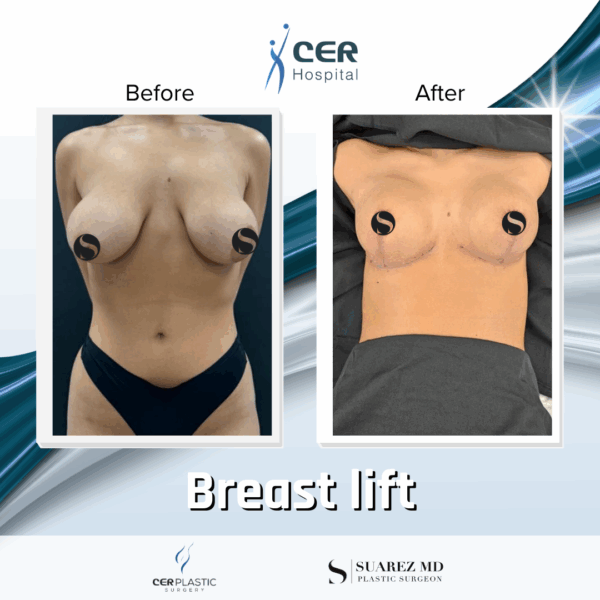 Breast Lift - 103 - Image 5