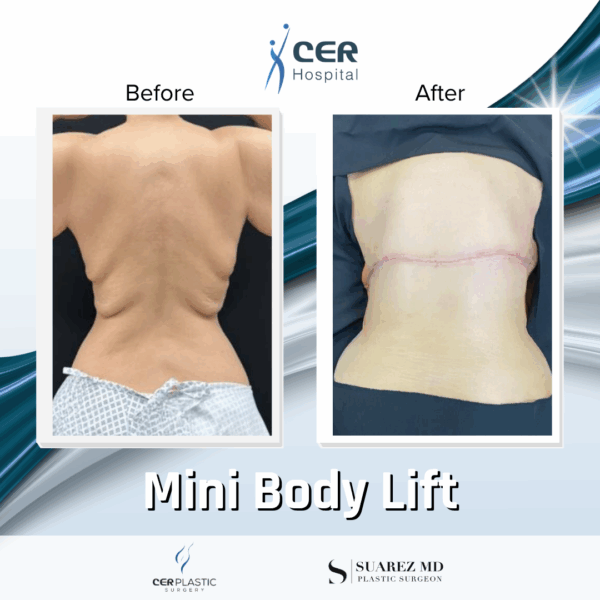 Mini Body Lift - 193 - Image 4