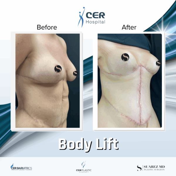 Body Lift - 243 - Image 4