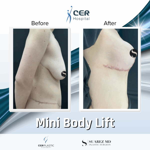 Body Lift - 094 - Image 5