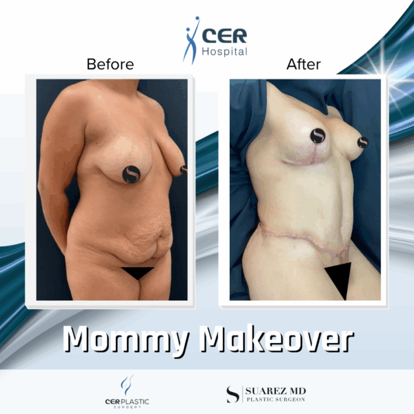 Mommy Makeover - 061 - Image 4