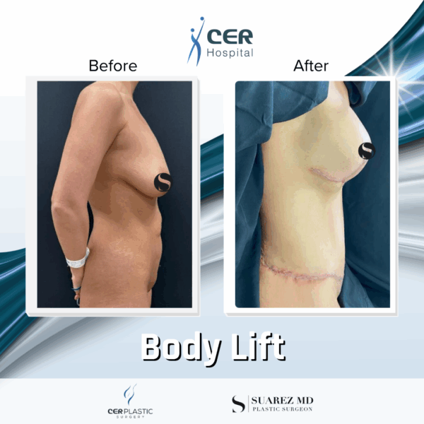 Body Lift - 125 - Image 5