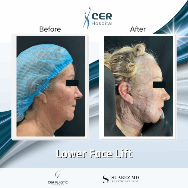 Lower Face Lift - 033 - Image 5