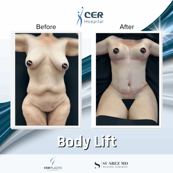 Body Lift - 165 - Image 5