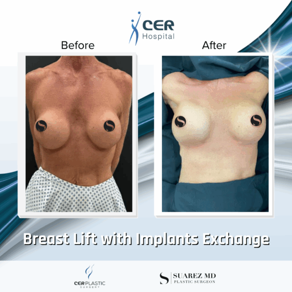 Breast Lift with Implants Exchange - 214 - Image 5