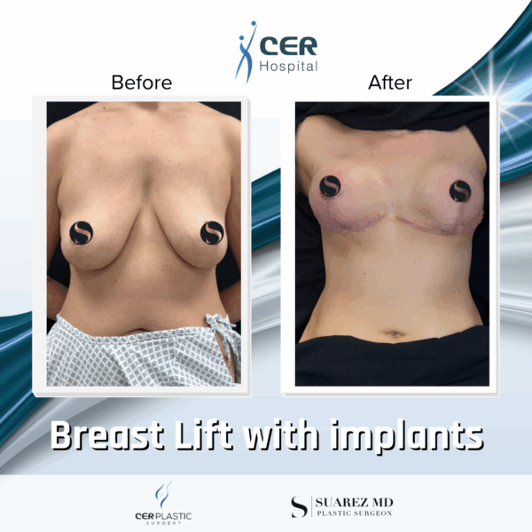 Breast Lift with Implants - 263