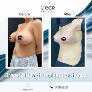 Breast Lift with Implants Exchange – 101