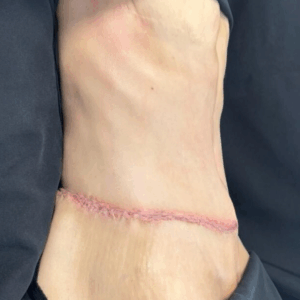 Circular Tummy Tuck – 056