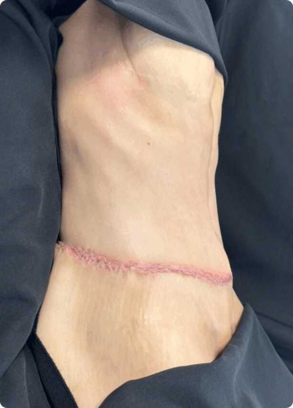 Circular Tummy Tuck - 056 - Image 2