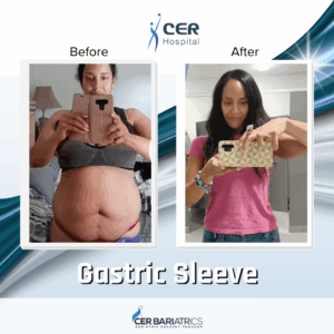 Gastric Sleeve